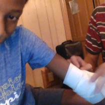 i think my brother broke my arm